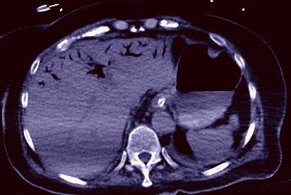 Portal venous gas due to SMA thrombosis and ischemic bowel
